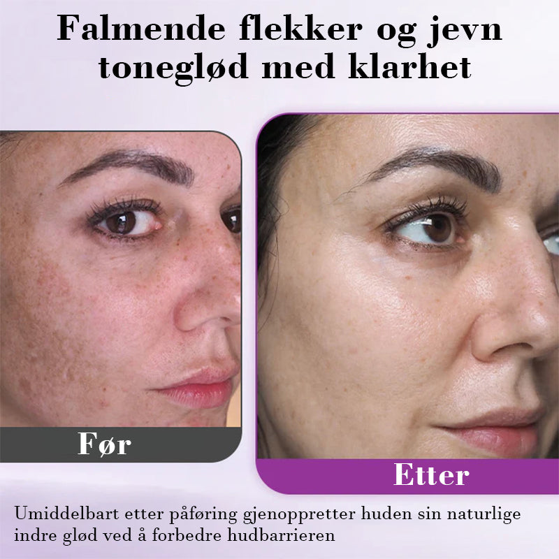 Avansert essens mot hyperpigmentering