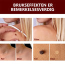 Essens for fjerning av flekker og føflekker - Kjøp 1 og få 1 gratis (2 stykk)