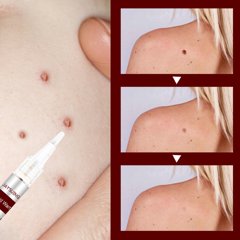 Essens for fjerning av flekker og føflekker - Kjøp 1 og få 1 gratis (2 stykk)