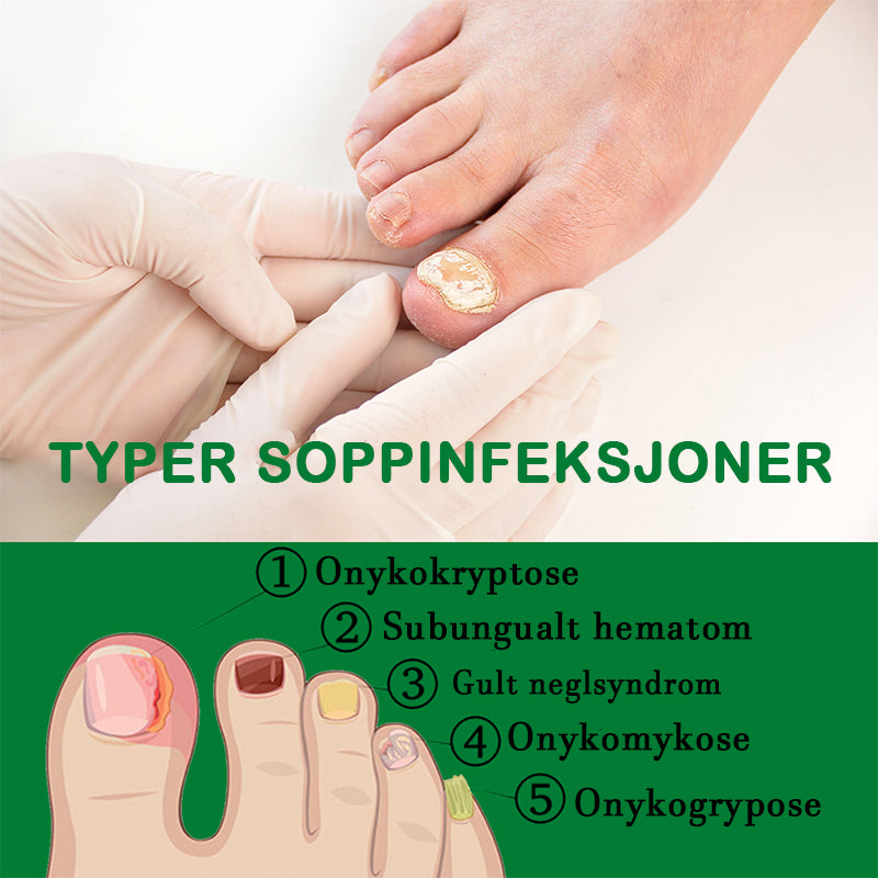 Neglepleie med ingefær