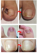 Lapper for neglekorrigering