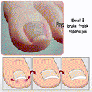 Lapper for neglekorrigering